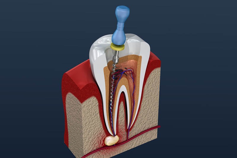 Painless root canal treatment Jaipur